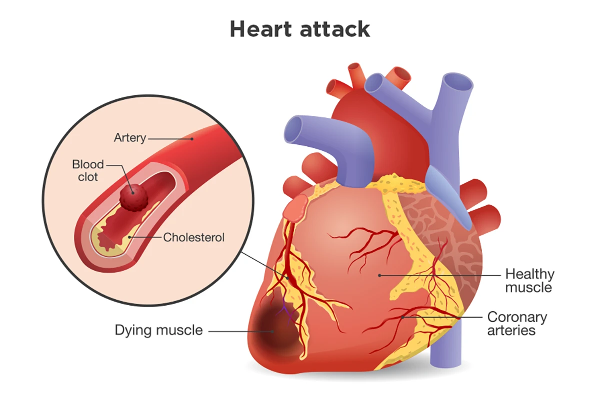Image shows a blood clot blocking an artery in the heart.