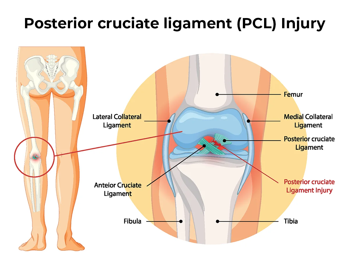 Illustration of many of the structures in the knee joint, with the PCL injury shown.