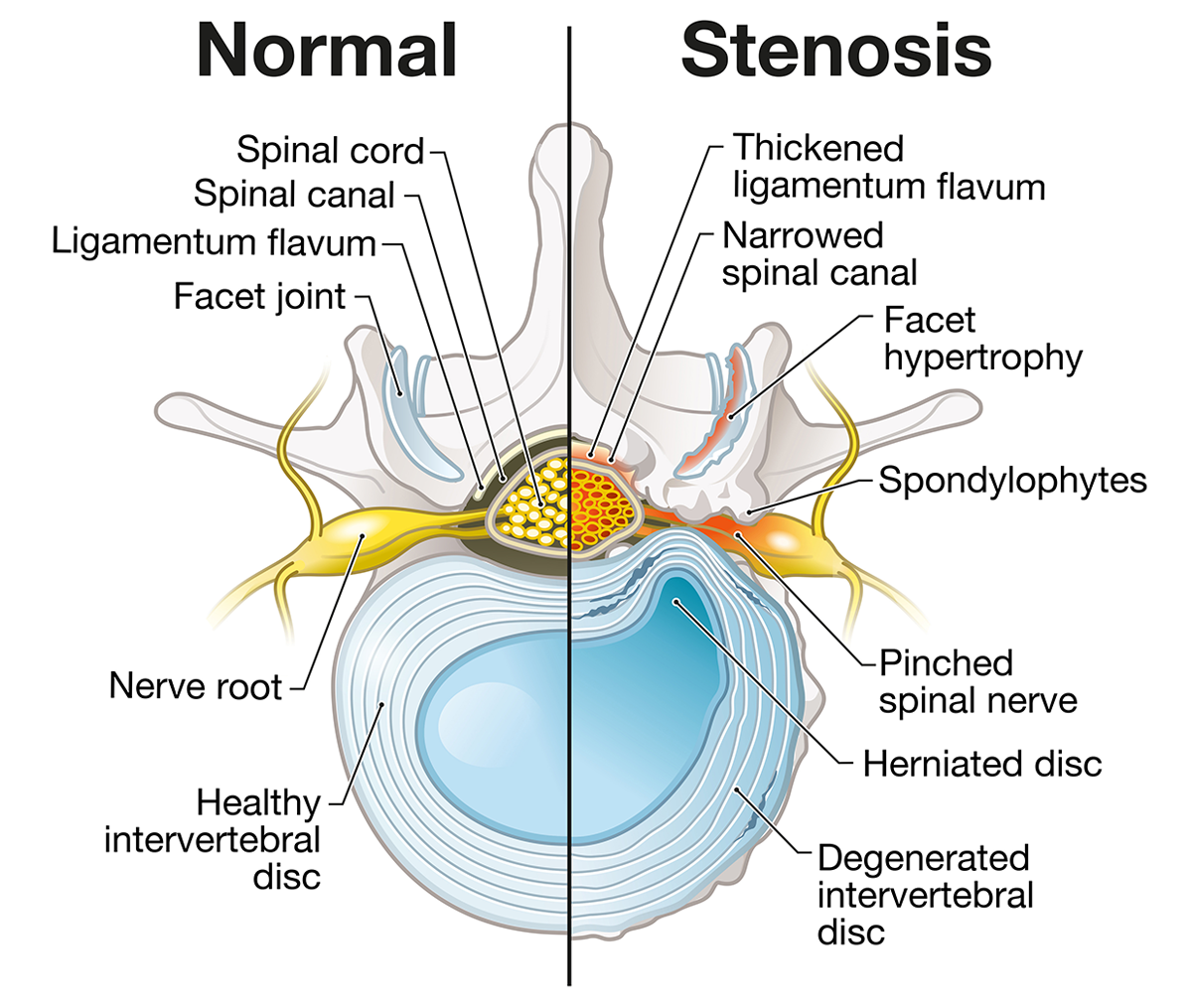 An illustration of a healthy spine next to one with spinal stenosis with labels explaining the differences between the two